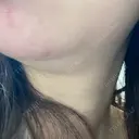 ハイフ（顔） 表参道メディカルクリニック 銀座院 BEFORE サムネイル用