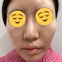その他（肌） / 美肌レーザー 湘南美容クリニック 静岡院 BEFORE サムネイル用