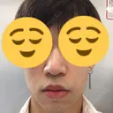 美容点滴・美容注射（美肌） / 美肌レーザー / フラクショナルレーザー（毛穴・ニキビ跡） 飯田橋駅前さくら坂クリニック BEFORE サムネイル用