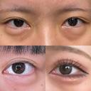 二重切開 / 目頭切開 / クマ治療 / 目尻切開 / 上まぶたたるみ取り / 下まぶたの脂肪取り / 脂肪注入（目の下） 湘南美容クリニック 大阪堺東院 BEFORE サムネイル用