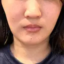 ルメッカ ルラ美容クリニック 大宮院 / ルラスキンクリニック 大宮院 BEFORE サムネイル用