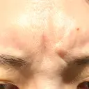 脂肪溶解注射（顔） / シワ取りボトックス / ボトックス（眉間） / ボトックス（目尻） TCB東京中央美容外科 梅田茶屋町院 BEFORE サムネイル用