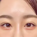 クマ治療 / ボトックス（エラ・小顔） / ヒアルロン酸注入（頬） TCB東京中央美容外科 京都駅前院 BEFORE サムネイル用