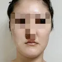 脂肪吸引（顔） 銀座マイアミ美容外科 BEFORE サムネイル用