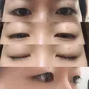 眼瞼下垂（切開） / 上まぶたの脂肪取り 白山クリニック 大分 BEFORE サムネイル用