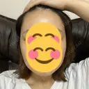 骨削り（エラ） / 脂肪吸引（顔） id（アイディ）美容外科 BEFORE サムネイル用