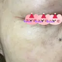 リジュラン 東京ココセランクリニック BEFORE サムネイル用