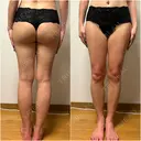 脂肪吸引（脚） / 豊胸（脂肪注入） GAYA body design clinic BEFORE サムネイル用