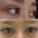 目尻切開 / 目尻靭帯移動 FROM B整形外科 (旧バウム整形外科) BEFORE サムネイル用