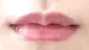 ヒアルロン酸注入（唇） / ボトックス（口角） ルラ美容クリニック 渋谷本院 BEFORE サムネイル用