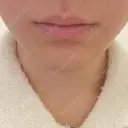 ボトックス（あご） / ヒアルロン酸注入（唇） / ボトックス（口角） ルラ美容クリニック 大阪本院 BEFORE サムネイル用