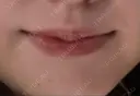 ヒアルロン酸注入（唇） 銀座美容外科クリニック 新宿院 BEFORE サムネイル用