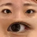 目頭切開 湘南美容クリニック 大阪心斎橋院 BEFORE サムネイル用