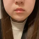 糸リフト / バッカルファット除去 / 脂肪吸引（顔） EMMA CLINIC（エマクリニック） BEFORE サムネイル用