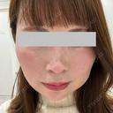 ヒアルロン酸注入（涙袋） / ボトックス（眉間） / ボトックス（目尻） ルラ美容クリニック 神戸院 BEFORE サムネイル用