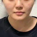 糸リフト 仙台TAクリニック BEFORE サムネイル用