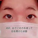 二重切開 / 眼瞼下垂（切開） 広島プルミエクリニック BEFORE サムネイル用