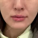 ヒアルロン酸注入（あご） 松倉クリニック 表参道 BEFORE サムネイル用