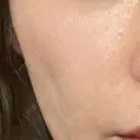 ヒアルロン酸注入（頬） oneUPclinic BEFORE サムネイル用