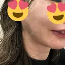 脂肪溶解注射（顔） 藤・ナチュレ美容クリニック 銀座院 BEFORE サムネイル用