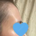 ヒアルロン酸注入（額） / ヒアルロン酸注入（こめかみ） LA CLEF CLINIC（ラクレクリニック） BEFORE サムネイル用