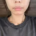 ボトックス（エラ・小顔） 一宮美容クリニック BEFORE サムネイル用