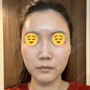 ボトックス（エラ・小顔） スキンリファインクリニック銀座 BEFORE サムネイル用