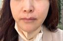 脂肪溶解注射（顔） 東京たかはしクリニック 練馬院 BEFORE サムネイル用