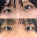 二重埋没 / 目頭切開 シンデレラ＆ダヴィンチクリニック BEFORE サムネイル用