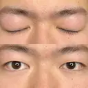 二重埋没 藤・ナチュレ美容クリニック 銀座院 BEFORE サムネイル用