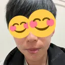 ボトックス（あご） / ヒアルロン酸注入（あご） / ヒアルロン酸注入（鼻翼基部） シェリークリニック 新宿本院 BEFORE サムネイル用