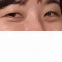 クマ治療 / 脂肪注入（肌） X CLINIC 大阪院 BEFORE サムネイル用