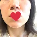 エレクトロポレーション / 毛穴洗浄（ハイドラフェイシャルなど） / ピコスポット 日比谷セントラルクリニック BEFORE サムネイル用