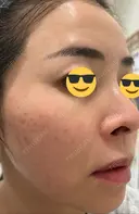 ハイフ（顔） 湘南美容クリニック 高崎院 BEFORE サムネイル用