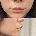 ボトックス（人中） Taide Suenaga Clinic（タイデスエナガクリニック） BEFORE サムネイル用