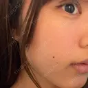 ピーリング（ニキビ・毛穴） / イオン導入 渋谷美容外科クリニック 横浜院 BEFORE サムネイル用