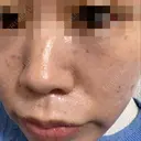 その他（肌） / 美肌レーザー / シミ取りレーザー / 美白レーザー / ピコスポット AURORA CLINIC（オーロラクリニック）新宿院 BEFORE サムネイル用