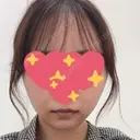 糸リフト / ボトックス（エラ・小顔） TCB東京中央美容外科 仙台駅前院 BEFORE サムネイル用