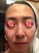 水光注射（ハリ・美肌） / ハイフ（顔） シロアム韓方美容・ダイエットクリニック(美&EYE) BEFORE サムネイル用