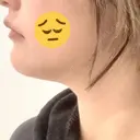 脂肪吸引（顔） / 脂肪吸引注射（顔） ziz CLINIC BEFORE サムネイル用