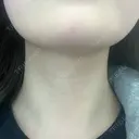 肌ヒアルロン酸注入（たるみ・シワ改善） ルラ美容クリニック 名古屋本院 BEFORE サムネイル用