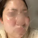 イオン導入 / 光治療（フォトフェイシャルなど） アムルーズ美容外科クリニック 大阪院 BEFORE サムネイル用