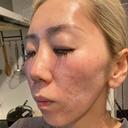ポテンツァ NARU Beauty Clinic 【ナルクリ】 BEFORE サムネイル用