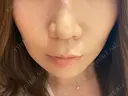 脂肪溶解注射（顔） SK新宿歌舞伎町美容外科・歯科 BEFORE サムネイル用