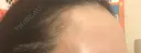 アートメイク（ヘアライン） Tokyo Tensei Clinic 新宿院 BEFORE サムネイル用