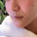 ニードルRF（ポテンツァなど） 東京美容外科 池袋院 BEFORE サムネイル用