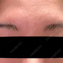 ボトックス（眉間） ルラ美容クリニック 神戸院 BEFORE サムネイル用