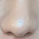 鼻孔縁挙上 大阪TAクリニック BEFORE サムネイル用