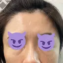 その他（目元） 聖心美容クリニック 六本木院 BEFORE サムネイル用