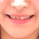 セラミック / その他（審美歯科/矯正歯科） 東京美容外科 赤坂院 BEFORE サムネイル用